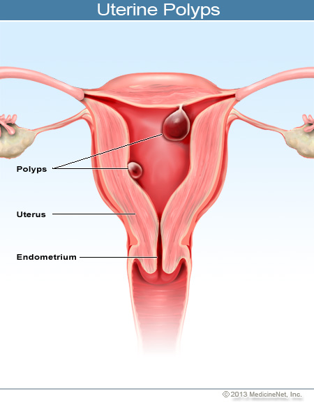 2013-illustration-uterine-polyps